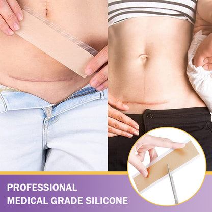 ✅Official Store |shinneey® Hyaluronic Acid Nano Microneedle Repair Tape🏥(Treatment of old and new scars, reduction of surgical scars, stretch marks, keloids, acne, burns, warts, dermatomes and varicose veins)